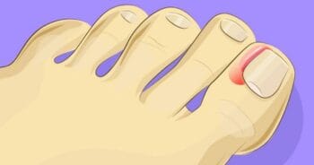 Unha Inflamada: Causas, Sintomas e Tratamentos Eficazes