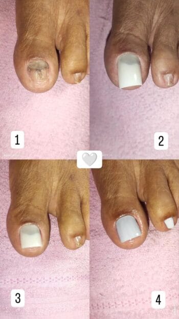 Unha Verde: Causas, Sintomas e Tratamento Eficaz