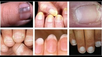 Unhas Fracas e Quebradiças: Causas e Soluções