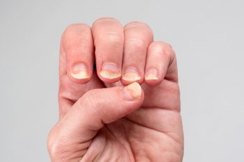 Dicas para unhas quebrando: como recuperar sua beleza